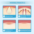 Acne pimple remendo hidrocolóide acne spot spot stands